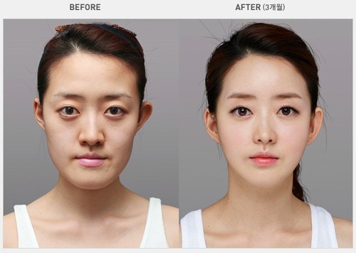 รวมภาพ Before & After ศัลยกรรมเกาหลี สุดยอด [ก่อน-หลัง ต่างกันมาก ...