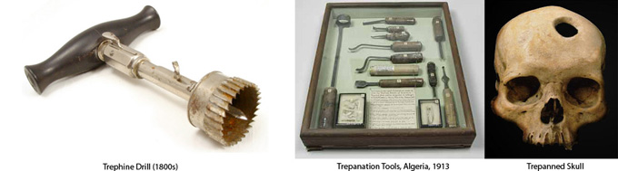 trepanation_tools